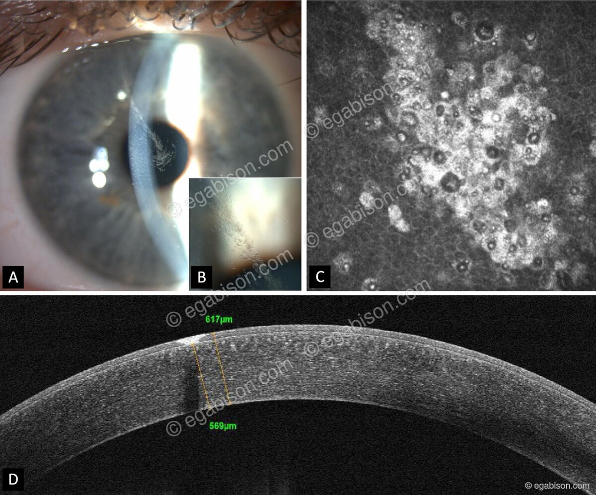 Lésion cornéenne — lampe à fente, microscopie confocale et OCT du segment antérieur