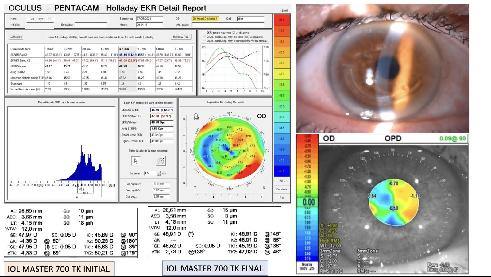 Pentacam Holladay EKR Detail Report et IOLMaster 700 TK (œil droit) : kératométrie équivalente et biométrie avant/après régularisation cornéenne