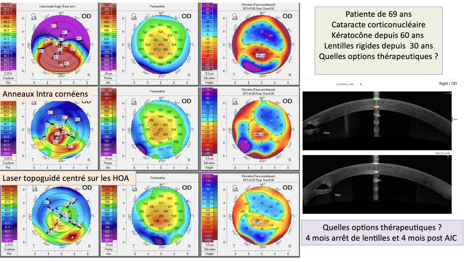 Suivi Pentacam (cartes axiale, pachymétrie, élévation postérieure) : état de base, après anneaux intracornéens, puis après laser topoguidé sur les HOA