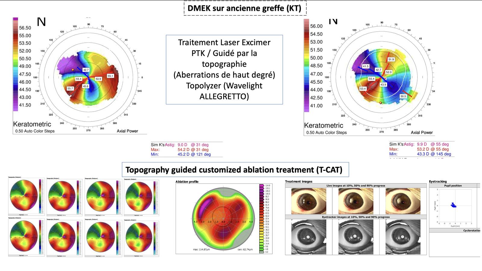 Laser excimer topoguidé T-CAT (Topolyzer Wavelight Allegretto), profil d'ablation personnalisé, et DMEK sur ancienne greffe