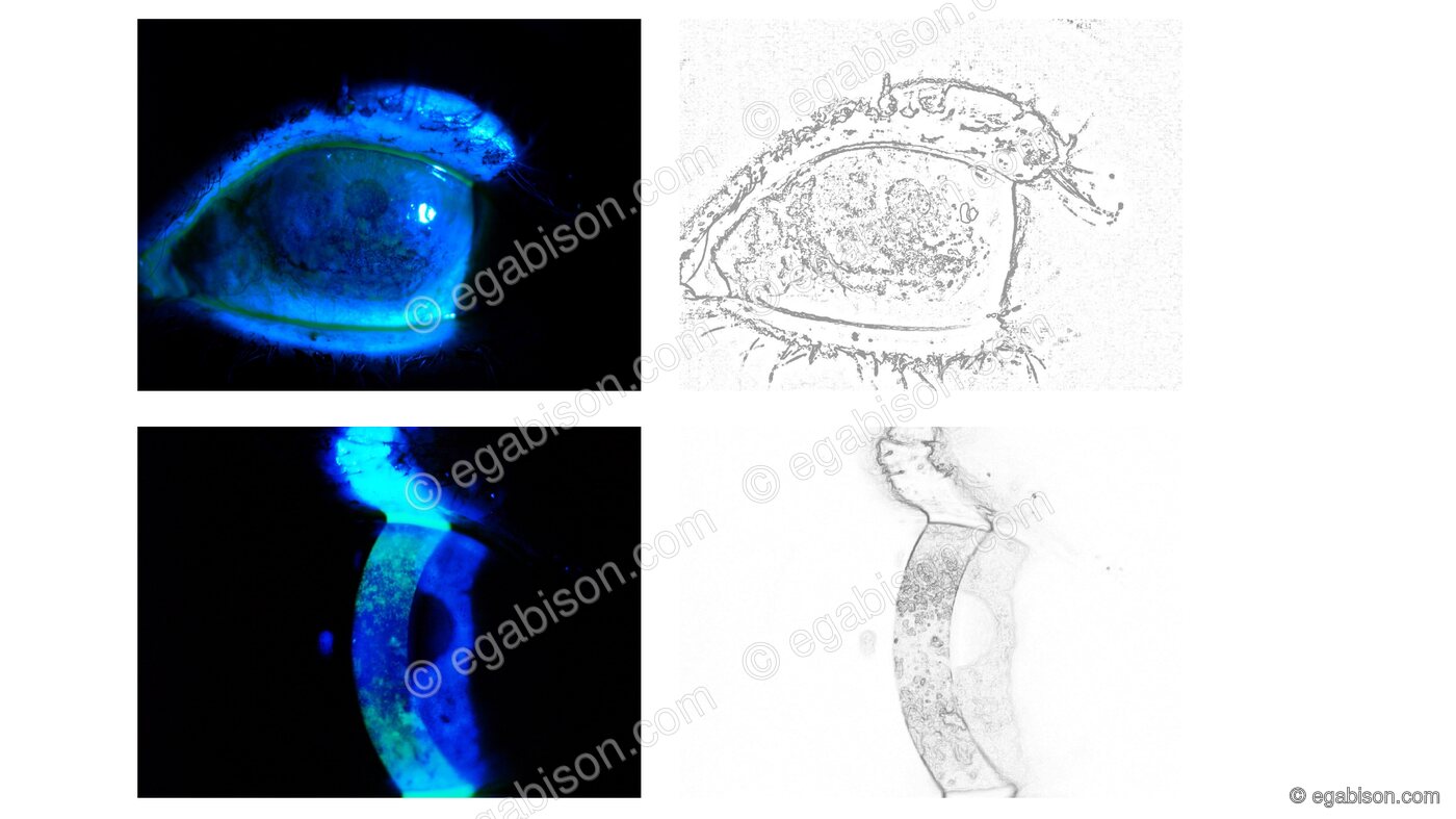 Kératite ponctuée superficielle en lumière bleue après fluorescéine