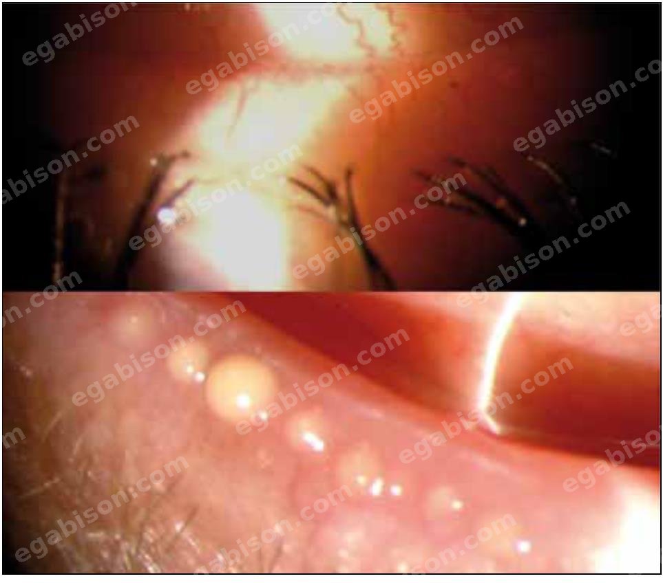 Figure 1 : Examen du bord libre palpébral à la lampe à fente : analyse des orifices meibomiens et du rebord ciliaire.