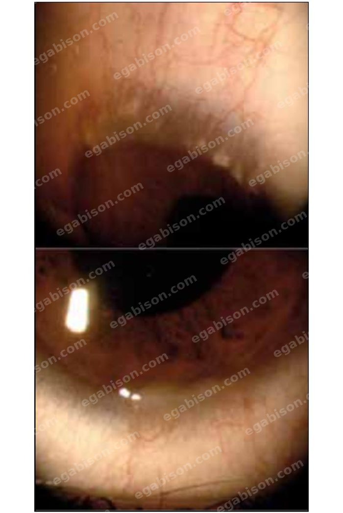Figure 2 : Grains de Trantas et bourrelet limbique gélatineux au cours d’une kérato-conjonctivite vernale (allergique).