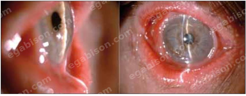 Figure 4 : Fibrose conjonctivale avec comblement des culs-de-sac conjonctivaux.