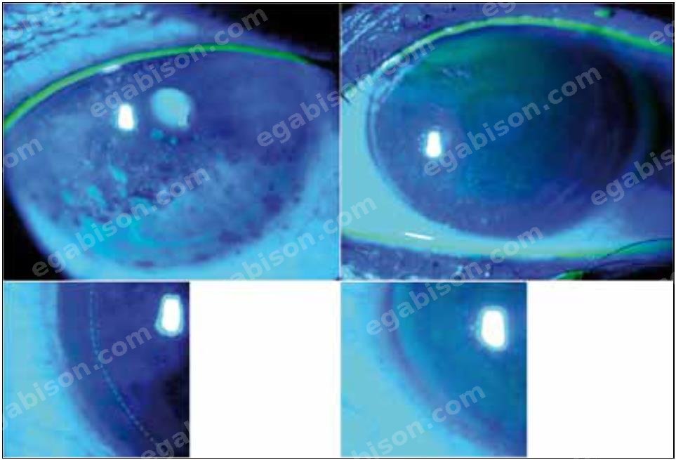 Figure 6 : Coloration de la surface oculaire à la fluorescéine en lumière bleue : kératite ponctuée superficielle de sévérité variable.