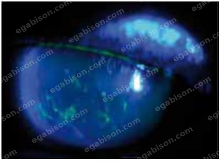 Figure 7 : Kératite filamenteuse : prise de fluorescéine par les filaments cornéens en lumière bleue.